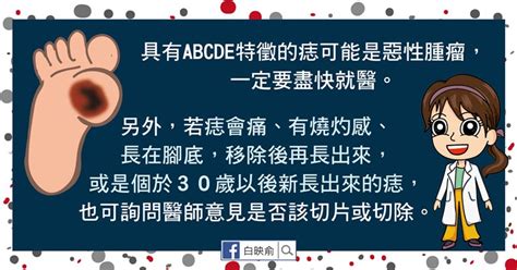 五歲長痣|我的「痣」會是惡性腫瘤嗎？醫師告訴你：符合這5特。